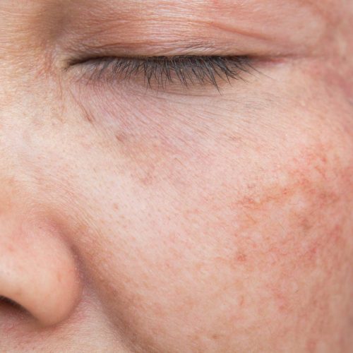 freckles on the face treatment in lahore