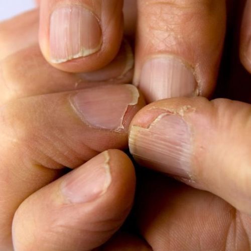 Brittle Nails Treatment in Lahore