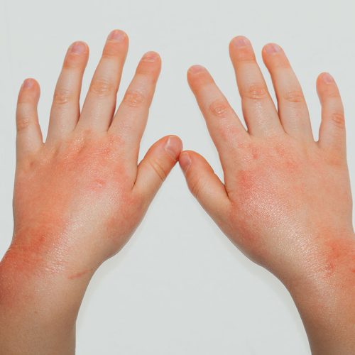Contact Dermatitis
