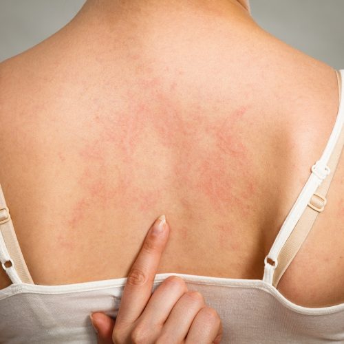 Health problem, skin diseases. Young woman showing her itchy back with allergy rash urticaria symptoms