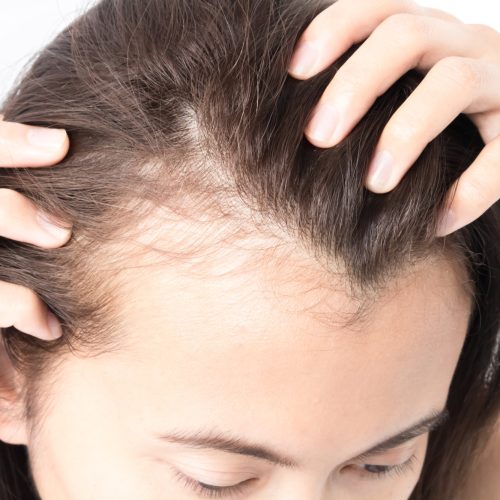 Woman serious hair loss problem for health care shampoo and beauty product concept