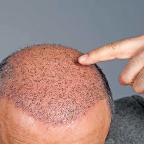Hair Transplant Surgery