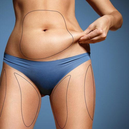 Liposuction treatment in lahore