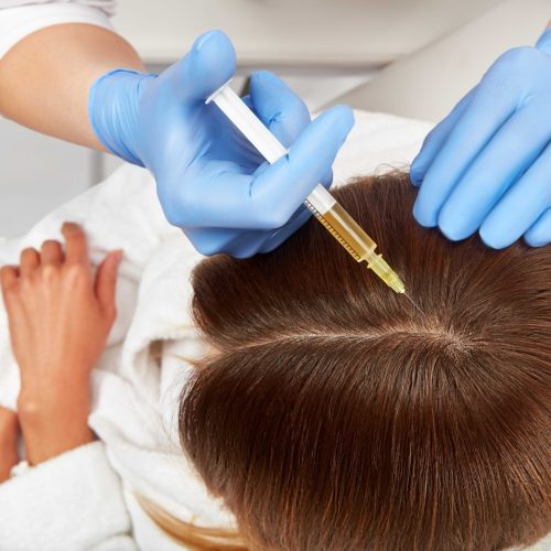 PRP For Hair Transplant