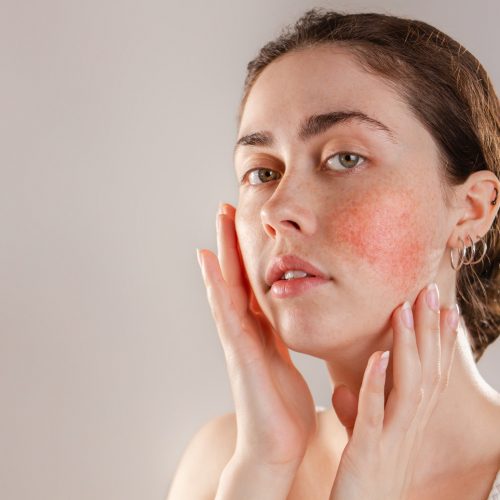 Medicine and cosmetology. Portrait of a young beautiful brunette woman with rosacea on her cheeks. Copy space.