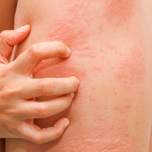 Women with symptoms of itchy urticaria.