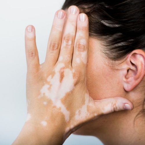Vitiligo