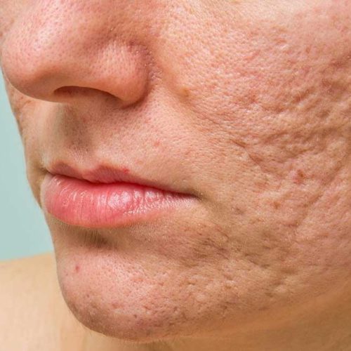 acne-scar-treatment